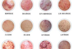 孕妇乳头出血是怎能么回事,孕期乳头出血原因有哪些