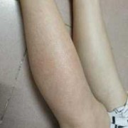 孕晚期，小腿痒怎么办,孕期小腿瘙痒怎么回事