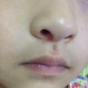 孕妇鼻子发炎可以涂红霉素眼膏吗,孕期鼻翼长痘是什么原因