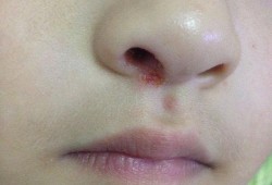孕妇鼻子发炎可以涂红霉素眼膏吗,孕期鼻翼长痘是什么原因