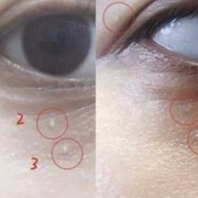 眼睛周围长脂肪粒原因,孕期脂肪粒越来越多