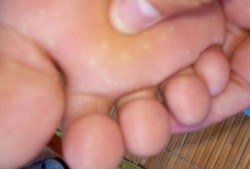 孕妇脚底起好多水泡怎么办,孕期嘴上起水泡怎么办图片