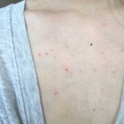 胸口上出现小红疙瘩,孕期胸口长痘痘怎么回事