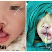 宝宝为什么会得裂唇，是遗传吗,胎儿裂唇是怎么形成的原因