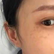 什么叫黄褐斑,孕期黄褐斑生完孩子会消失吗