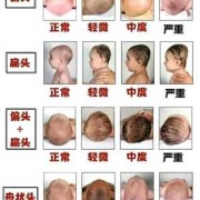 脑袋扁怎么变圆,胎儿头扁属于畸形吗图片