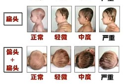 脑袋扁怎么变圆,胎儿头扁属于畸形吗图片