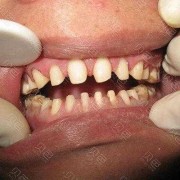 孕期牙齿缺（全瓷牙缺了还能补吗，靠近牙龈处掉了一小块）