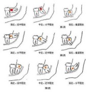 孕期可以拔智齿吗（孕期可以拔智齿吗?）