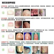孕妇灰指甲对胎儿有影响吗（孕妇灰指甲对胎儿有影响吗图片）