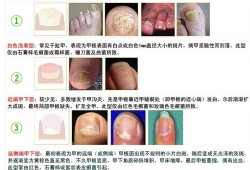 孕妇灰指甲对胎儿有影响吗（孕妇灰指甲对胎儿有影响吗图片）