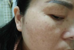 孕期长斑（孕期长斑怎么控制和消除）