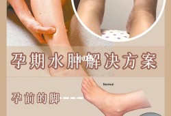 缓解孕期水肿（孕妇脚浮肿怎么缓解?怀孕九个多月，水肿很厉害有什么办法能改善）