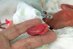 早产胎儿（孕35周早产宝宝有事吗？宝宝成活率高吗）