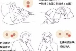 孕期乳房白点（经常堵奶。要怎么办，里面白点溶挤出来以后过几天又有白点）