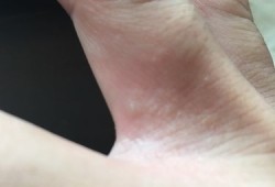 孕期手脚长水泡很痒（孕期手脚长水泡很痒怎么回事）