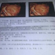 胎儿脊椎成串珠状男孩（胎儿脊柱呈串珠状排列是男孩女孩）
