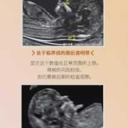 胎儿nt增厚怎么办（做nt被医生说腹壁太厚）