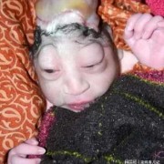 羊水过多胎儿畸形风险多大,胎儿头大畸形可能性大吗
