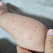 5个月胎儿图片（5个月宝宝身上起疙瘩怎么办）