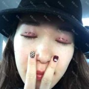 越南人都是双眼皮吗,孕期变双眼皮怎么办