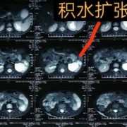 肾盂扩张是什么意思,胎儿双肾盂扩张是什么意思啊