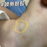 胎儿在鼓包（胎儿在鼓包是什么部位）