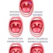 孕期喉咙疼怎么办（孕期喉咙疼怎么办最简单的方法）