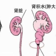 孕妇肾积水怎么办,胎儿肾积水是什么原因引起的