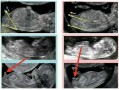 胎儿3个月男女区别图（胎儿3个月男女区别图NT）