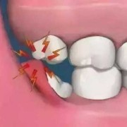 孕期可以拔牙齿吗（孕期可以拔牙齿吗有影响吗）