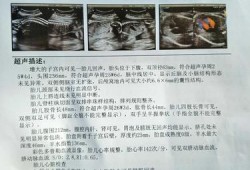 胎儿后脑窝（胎儿后脑窝池增宽13mm会脑瘫吗）