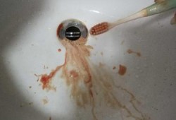 孕妇能刷牙洗脸吗,孕期刷牙总是出血是什么原因