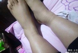 孕期腿肿了（孕期腿肿了怎么消肿最快）