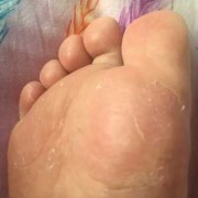 孕妇胆汁酸高的症状,孕期胆汁酸高症状图片大全