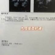 孕期宫腔积液怎样治疗（孕期宫腔积液怎样治疗快好）