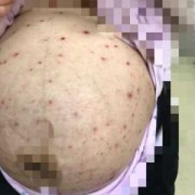 孕妇起水痘怎么办,孕妇得水痘影响胎儿吗知乎