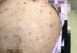 孕妇起水痘怎么办,孕妇得水痘影响胎儿吗知乎