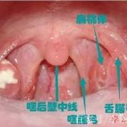 备孕期间扁桃体发炎（备孕期间扁桃体发炎怎么办最简单的方法）