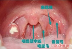 备孕期间扁桃体发炎（备孕期间扁桃体发炎怎么办最简单的方法）