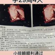 孕29周胎儿腿短怎么办？我怀孕29周，b超显示胎儿股骨长5.4,胎儿腿短5周怎么办