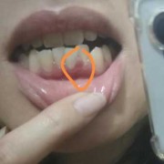孕期牙龈肿胀（牙龈肿了，怎么可以快速消肿）