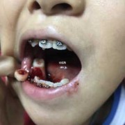 怀孕期间牙齿掉了一半（怀孕期间牙齿掉了一半的原因）