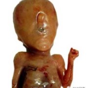 胎儿小脑症（胎儿小脑症是什么引起的）