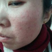 孕期面部皮炎（孕期面部皮炎）