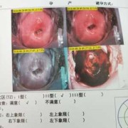 孕早期宫颈息肉流血怎么办,孕期宫颈息肉出血怎么止血