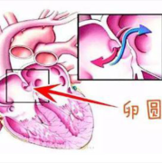 卵圆孔未闭怎么办？是不是新生儿都是闭合的,胎儿卵圆孔提前闭合与妊娠结局的临床分析