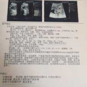 单脐动脉对胎儿有什么影响（胎儿单脐动脉会有什么影响）