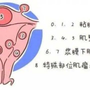 孕期发现子宫肌瘤（妊娠合并子宫肌瘤怎么治疗）