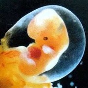 胎儿羊水浑浊（孩子出生的时候是羊水浑浊）